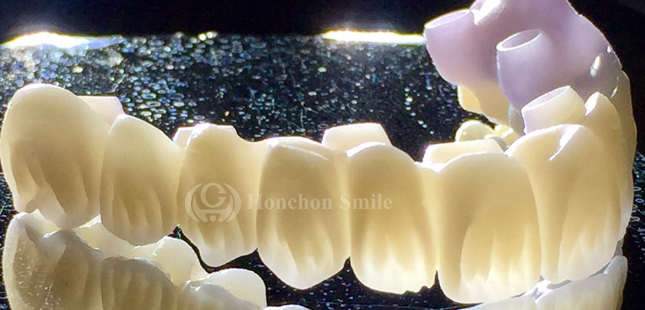 SHT Case ( Super High Translucent Zirconia)