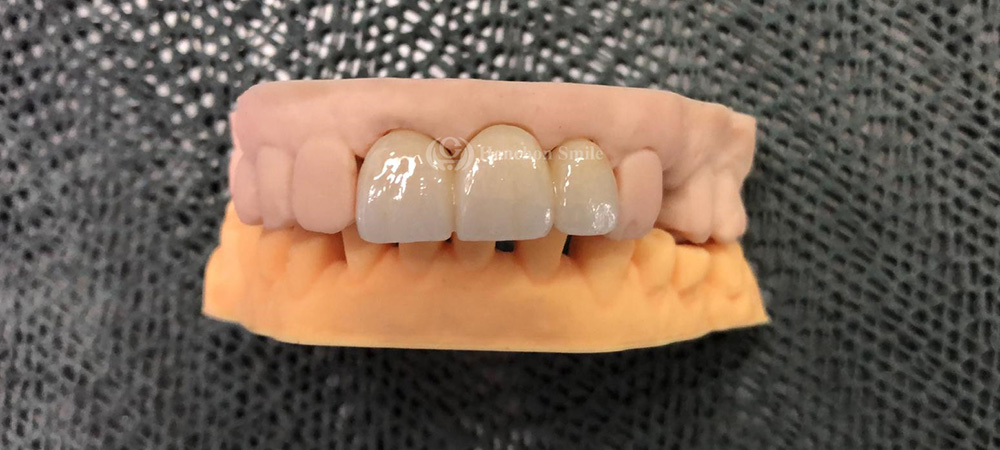 UT-ML Case( Ultra Translucent Multilayer Zirconia)