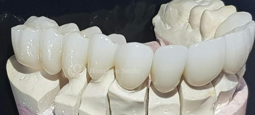 ST-ML Case ( Super Translucent Multilayer Zirconia)