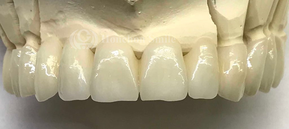 ST PLUS Case ( Super Translucent PLUS Zirconia)