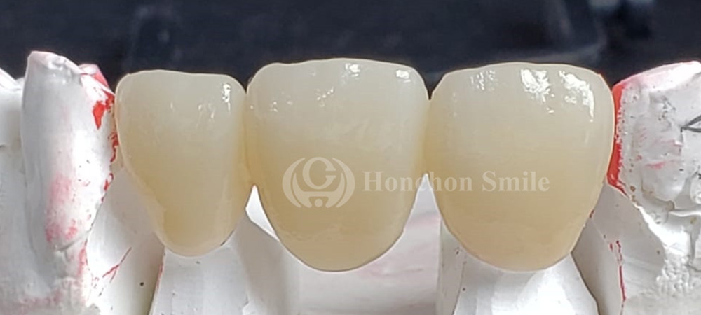 HC4D-ML Case( HC4D Multilayer Zirconia)