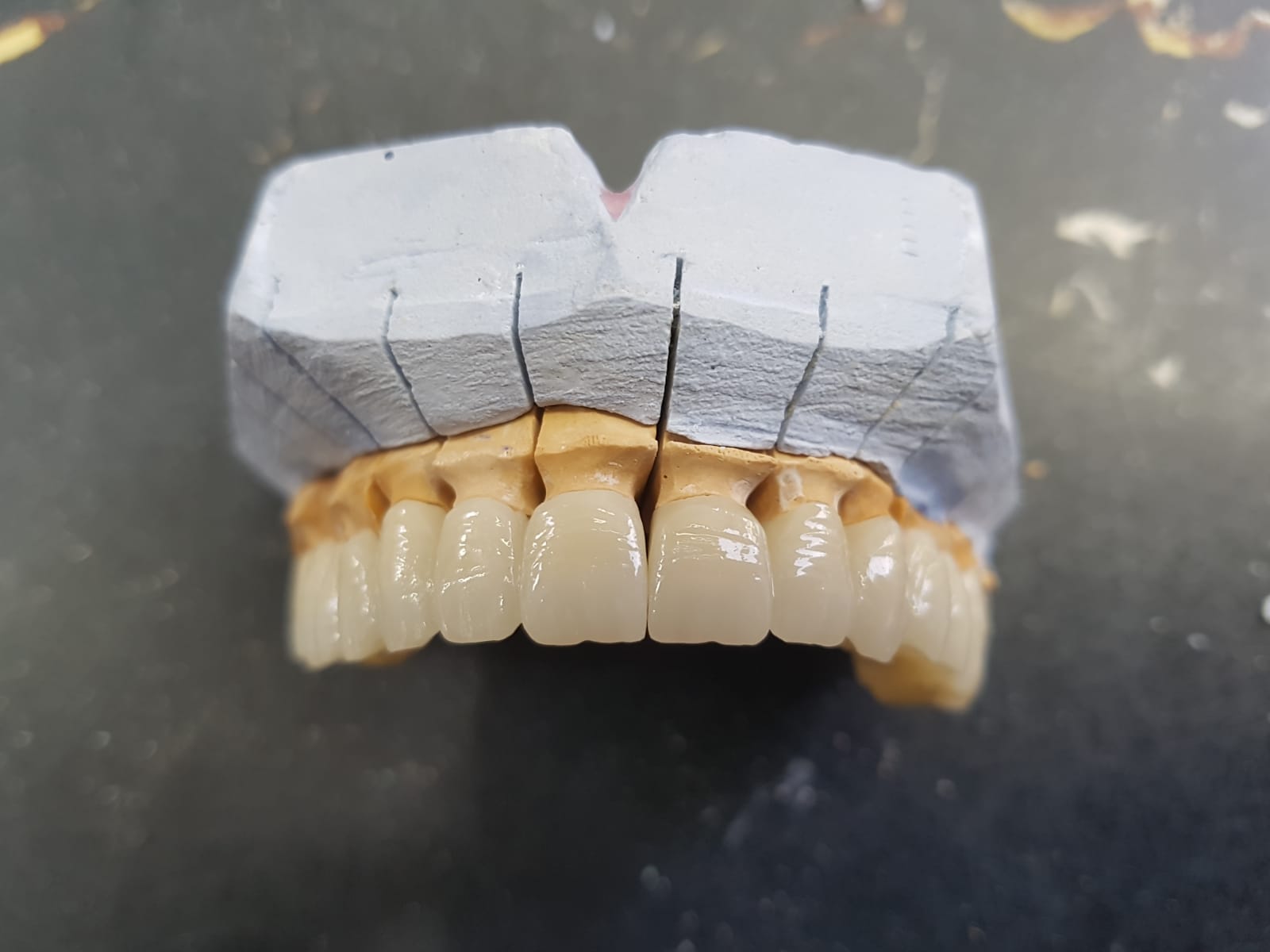 Comparative Insights: Zirconia Blocks vs. Conventional Dental Restorative Materials