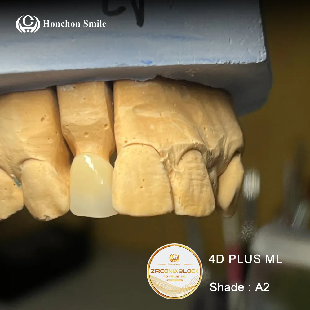 Do Zirconia Restorations Have a High Chipping Rate?