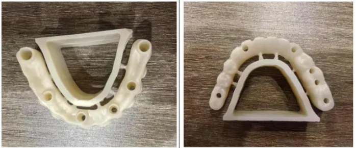 Common Causes of Zirconia Crown Fracture & How to Avoid Them (Pre-Sintering Stage)